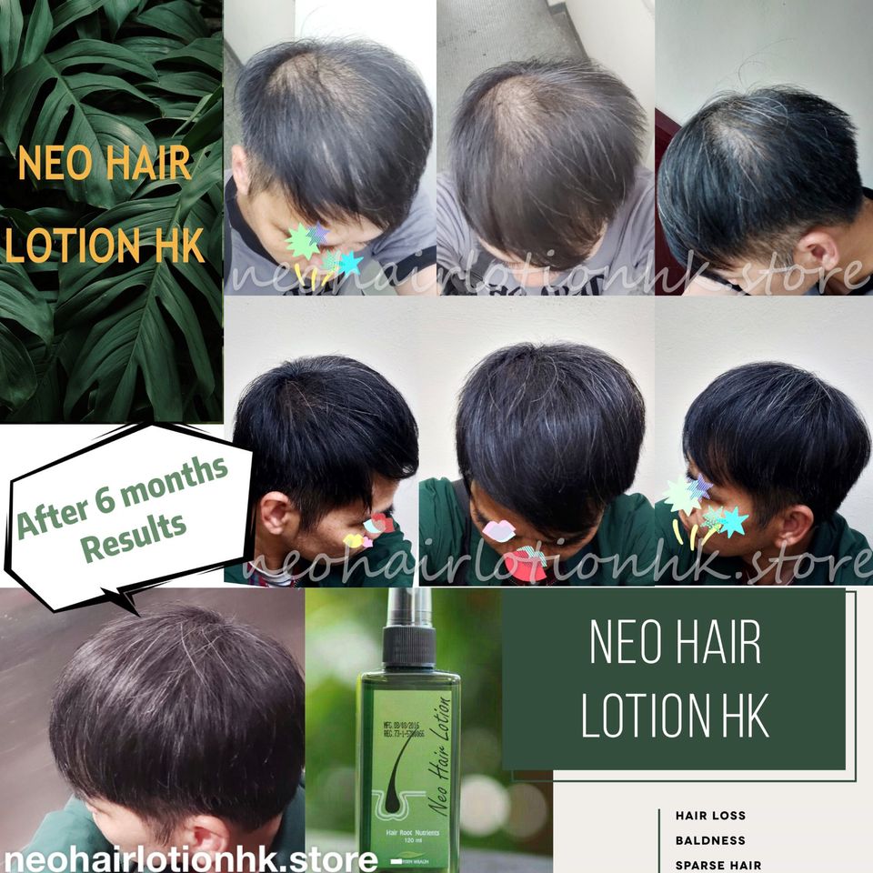 HAIR-REBORN☘️-Neo-Hair-Lotion-????For--3-B Neo Hair Lotion HK | Sajy Neo  Hair Regrowth Lotion Haircare Hair Loss Oil Baldness/ Derma Rollerwanan) |  