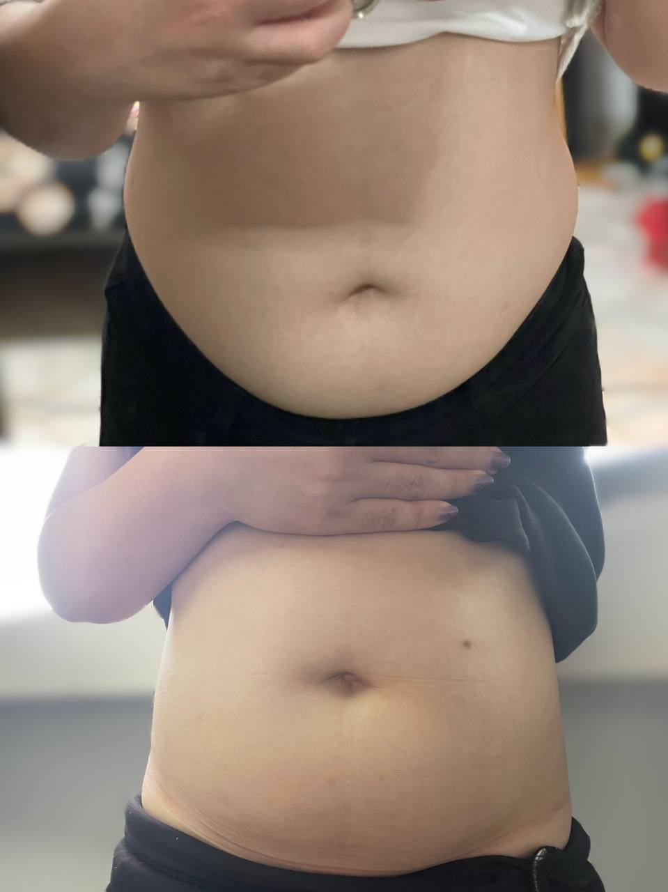 🇲🇾 5 盒 完整一个疗程配套 （ 可服用 30-45 天 ）