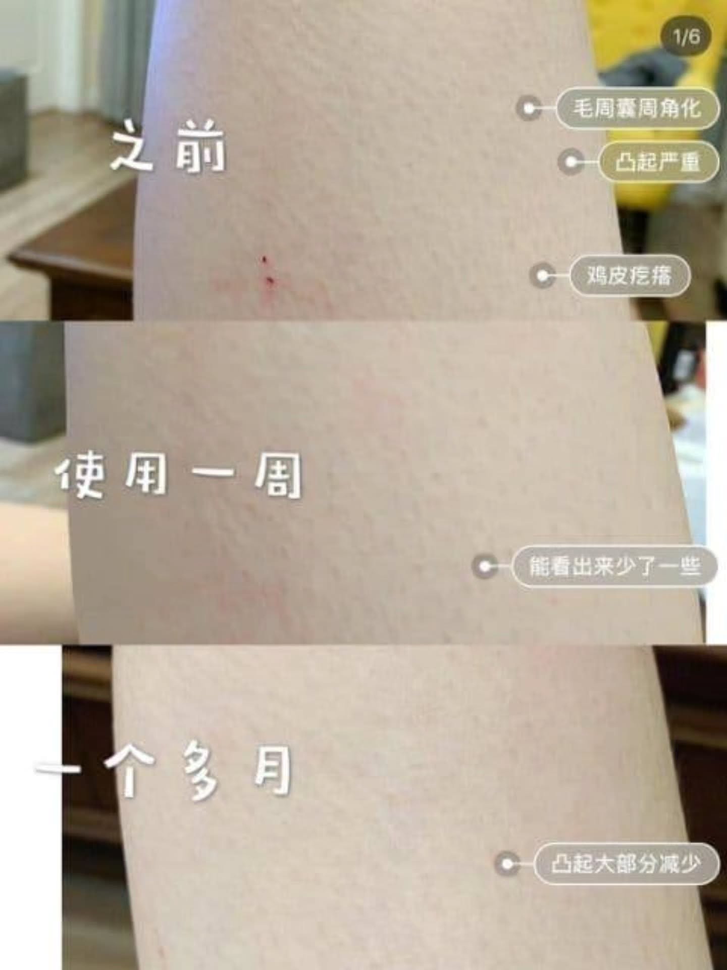 🇯🇵【日本小林制药祛鸡皮膏】30G