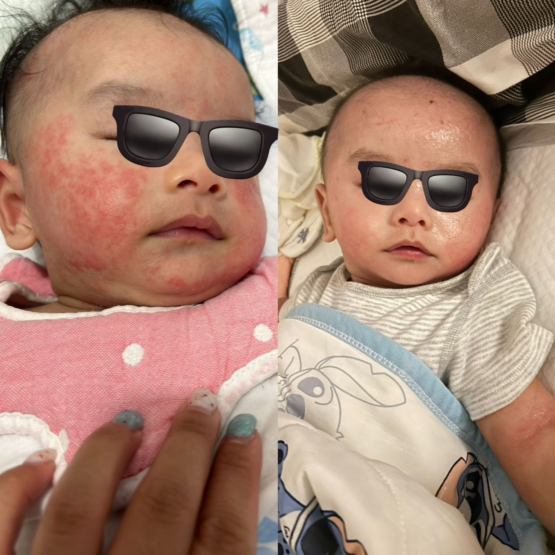 【BB面仔濕疹】安睡止痕・急救紅卜卜套裝