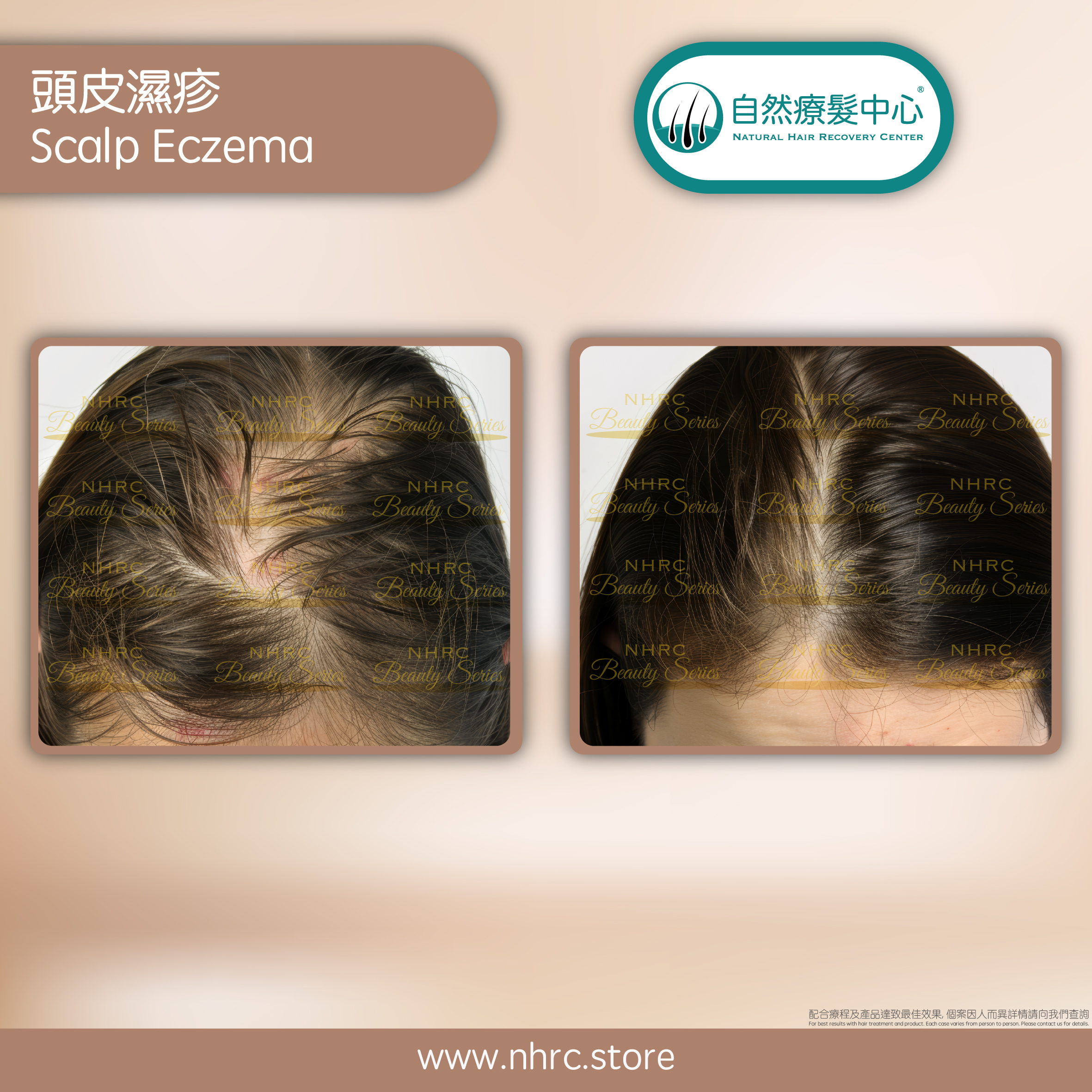 頭皮濕疹Scalp Eczema