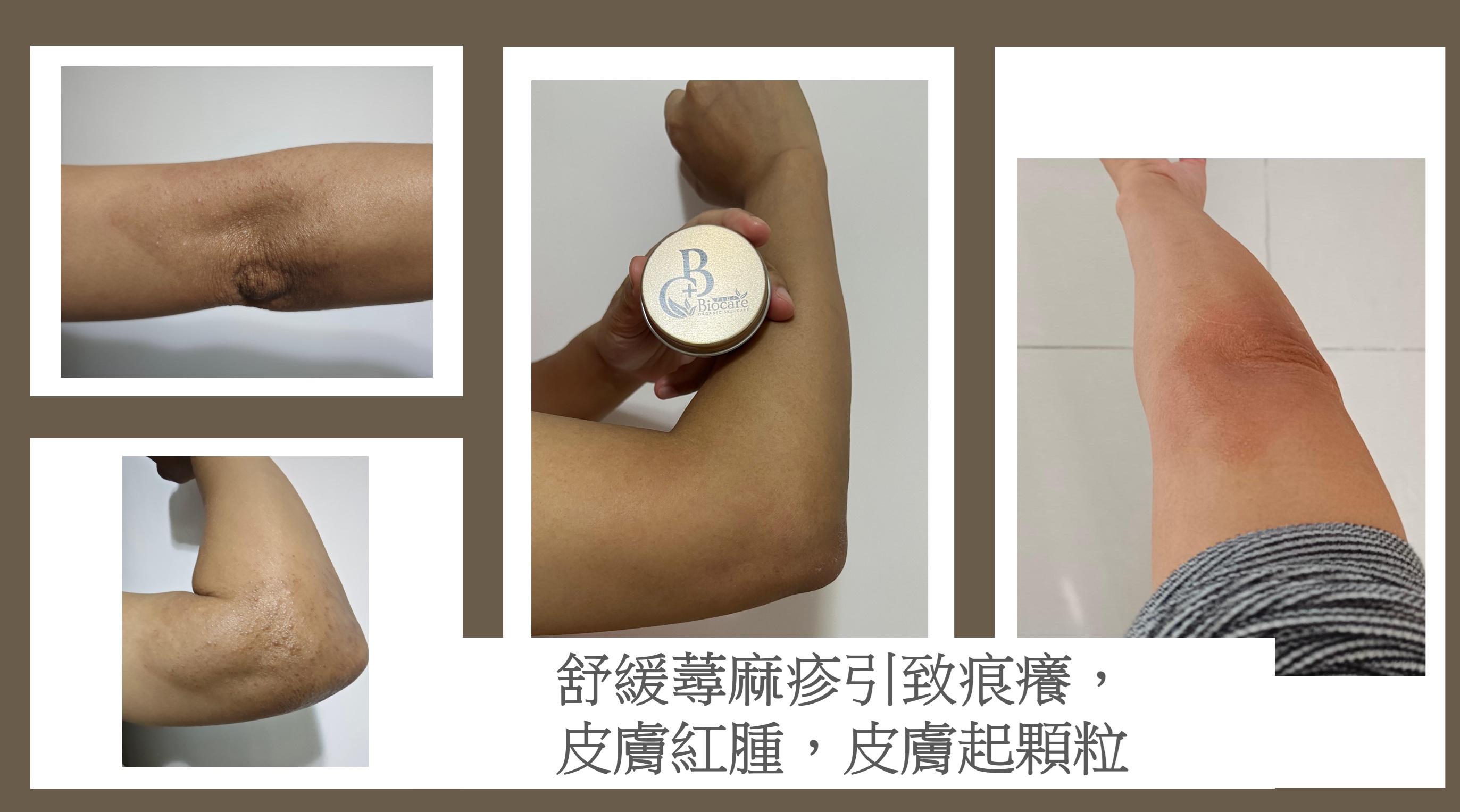 有機扁桃斑鳩菊油膏(嬰兒款)-蚊叮蟲咬/消腫止痕/濕疹/尿布疹及奶癬(出口包裝)
