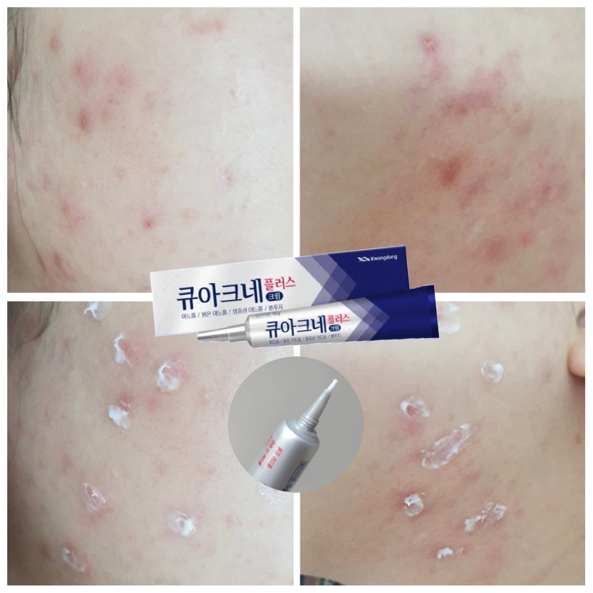 韓國Kwangdong Q-Acne Plus cream 祛痘消炎暗瘡膏 15g