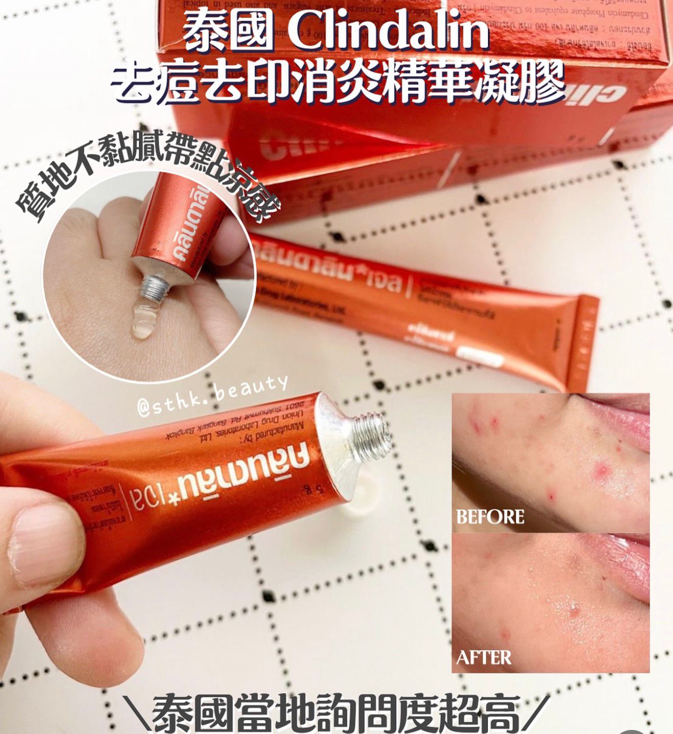 【預訂】泰國暗瘡膏 5g