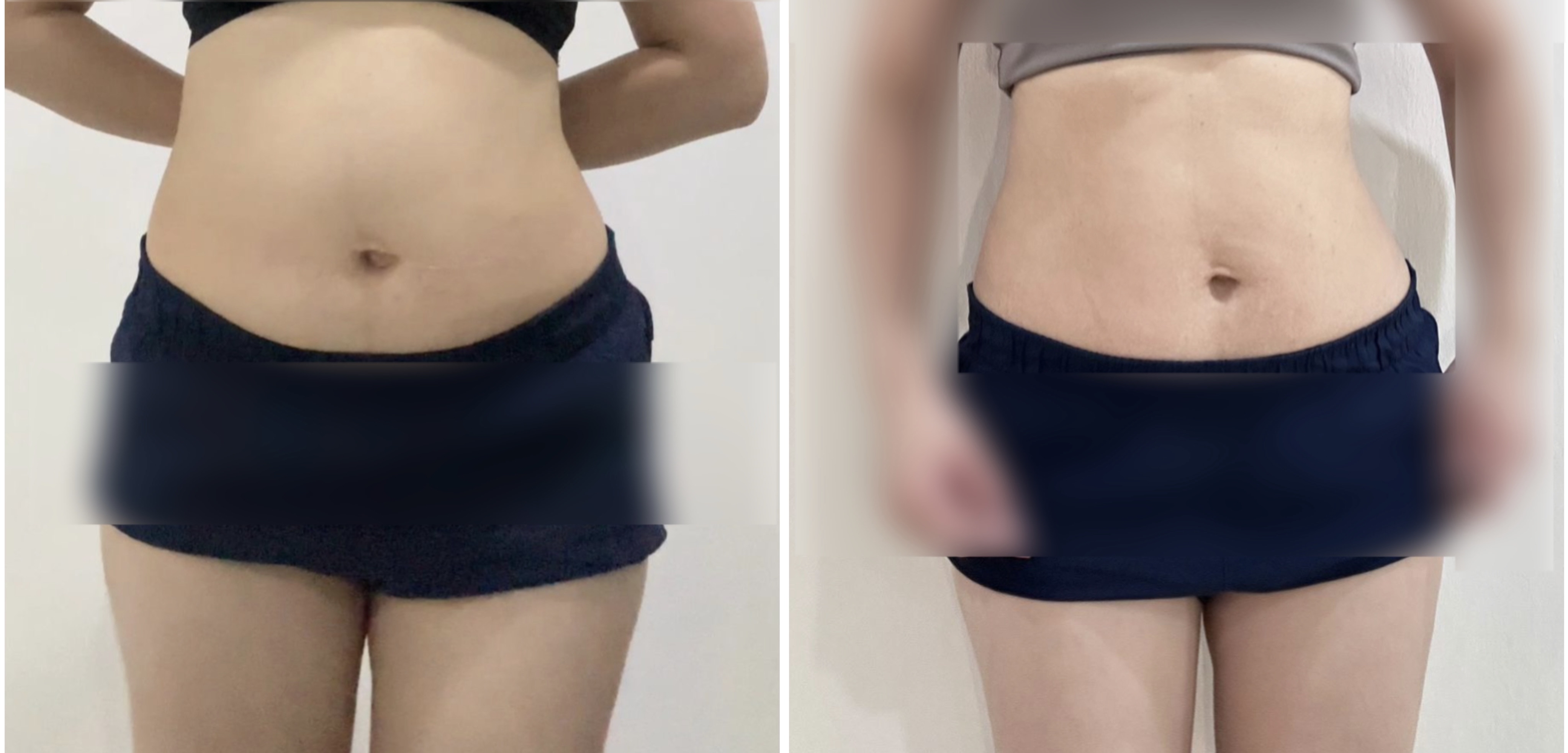 🇲🇾 5 盒 完整一个疗程配套 （ 可服用 30-45 天 ）