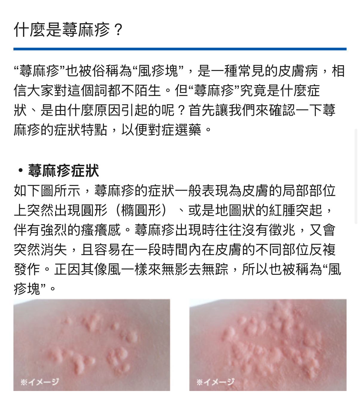 日本 曼秀雷敦 蕁麻疹軟膏 15g｜止癢｜抗炎｜鎮靜肌膚｜不含類固醇