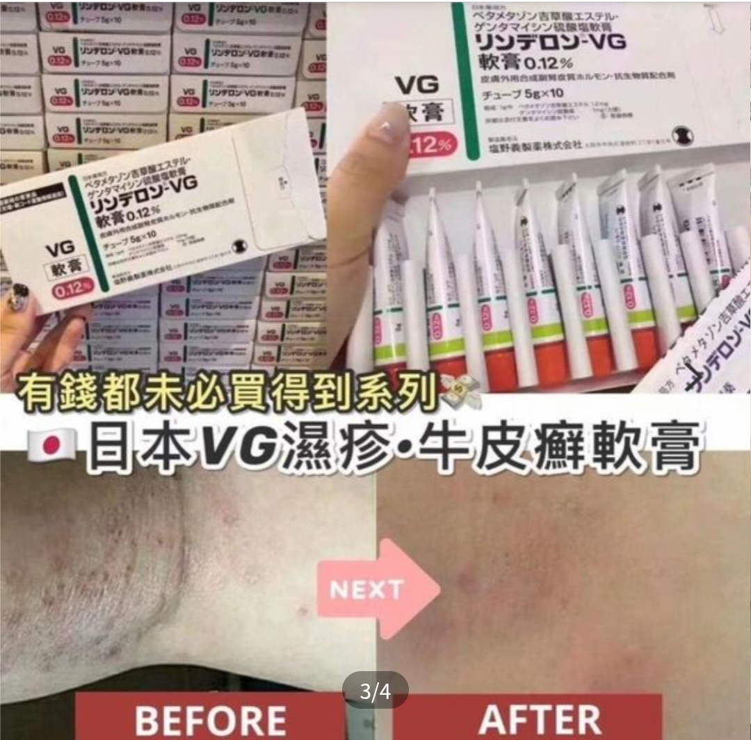 日本VG濕疹牛皮痛軟膏5g