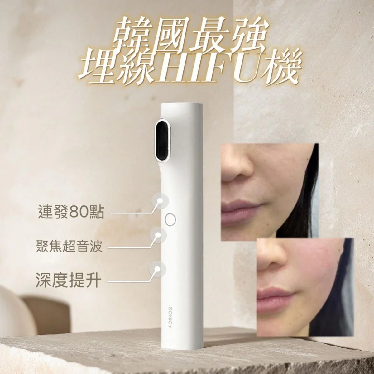 韓國製INNOCERA Sonic+80HIFU聚焦超聲波埋線HIFU機 送導入GEL(訂貨4-7天)