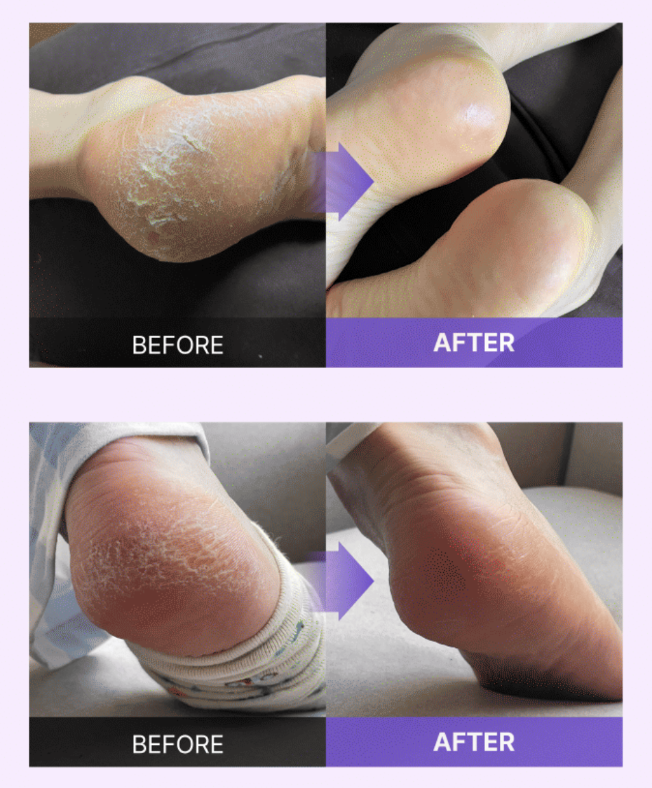 LIZ 媽媽推介｜韓國Baren 足部去角質 磨皮修護 美足套裝｜Foot Callus Eraser Home Set 