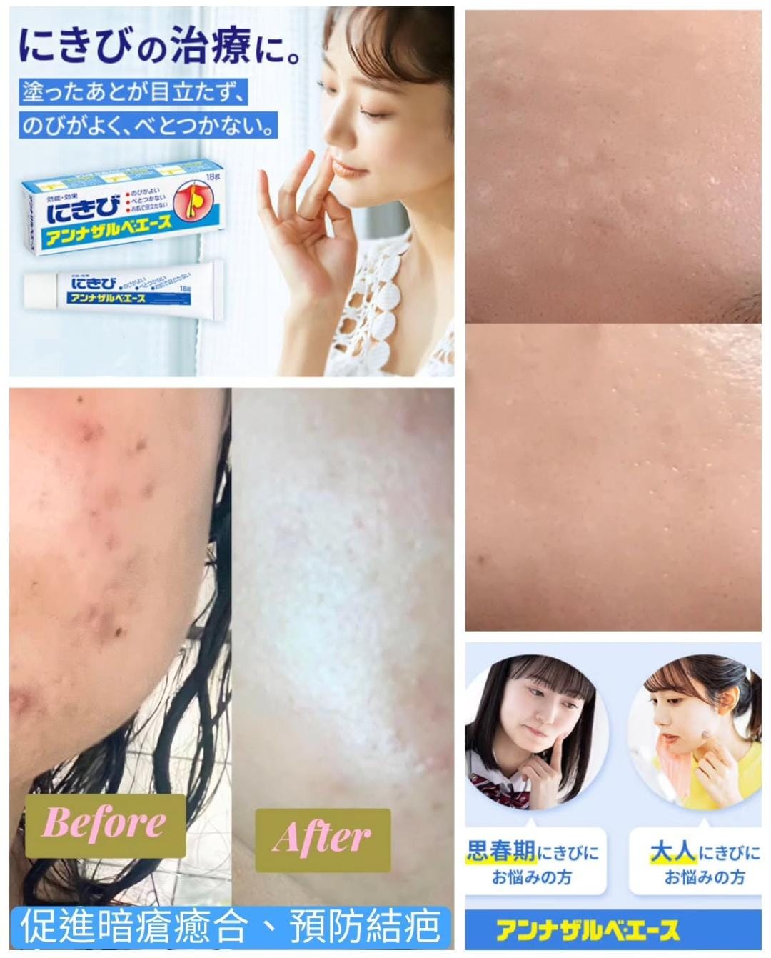 日本版白兔牌暗瘡膏