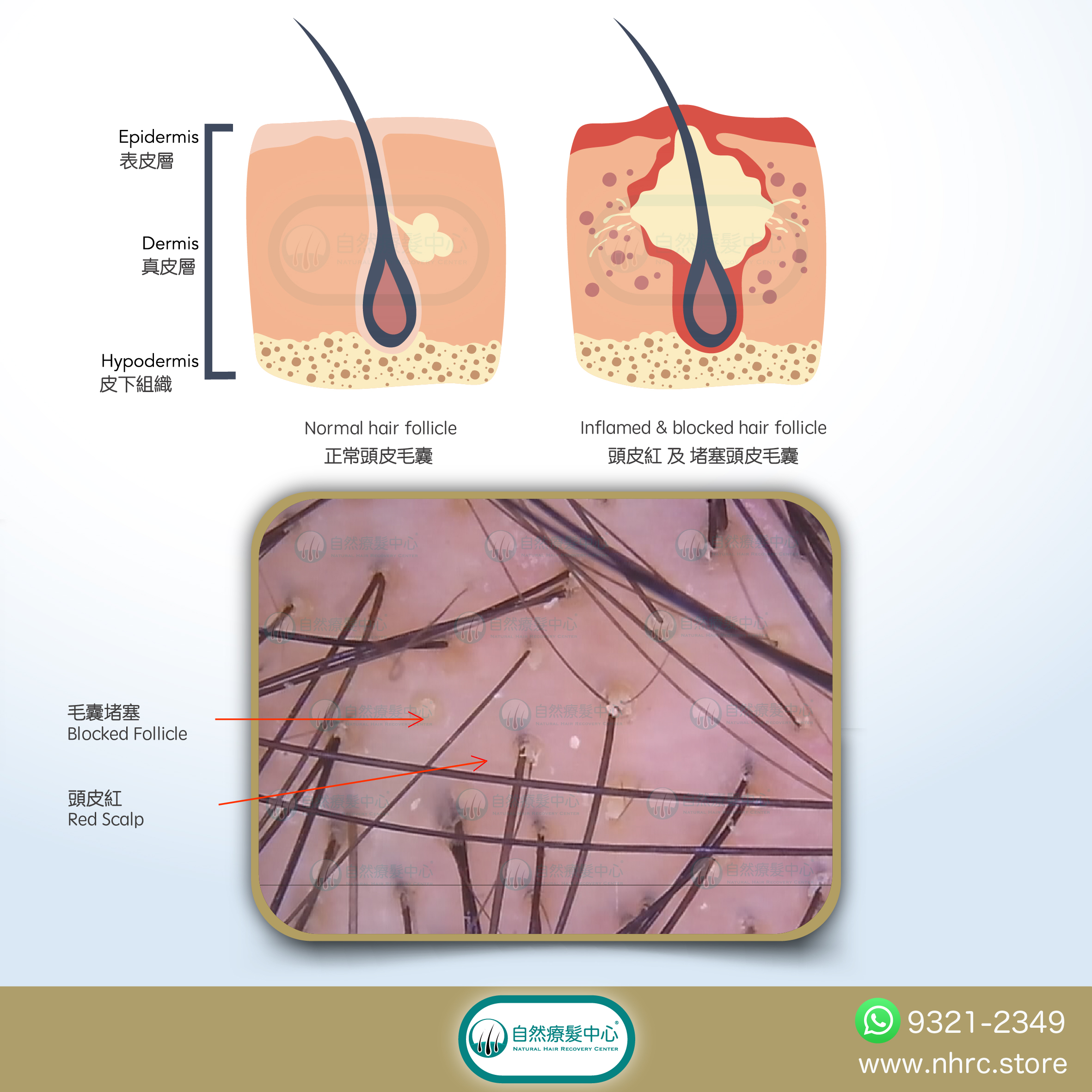 頭皮發炎Scalp Inflammation