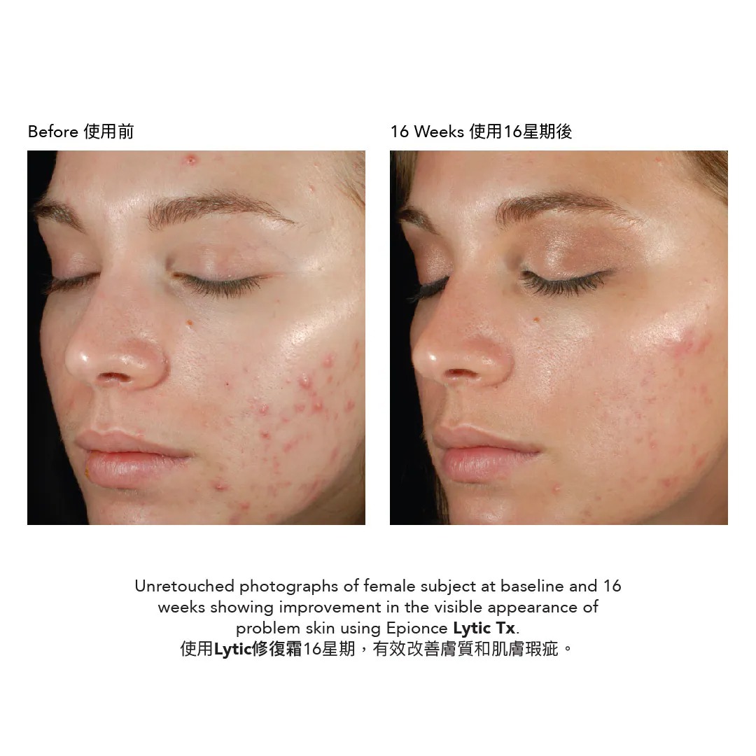 Epionce Lytic Tx Retexturizing Lotion 修復霜