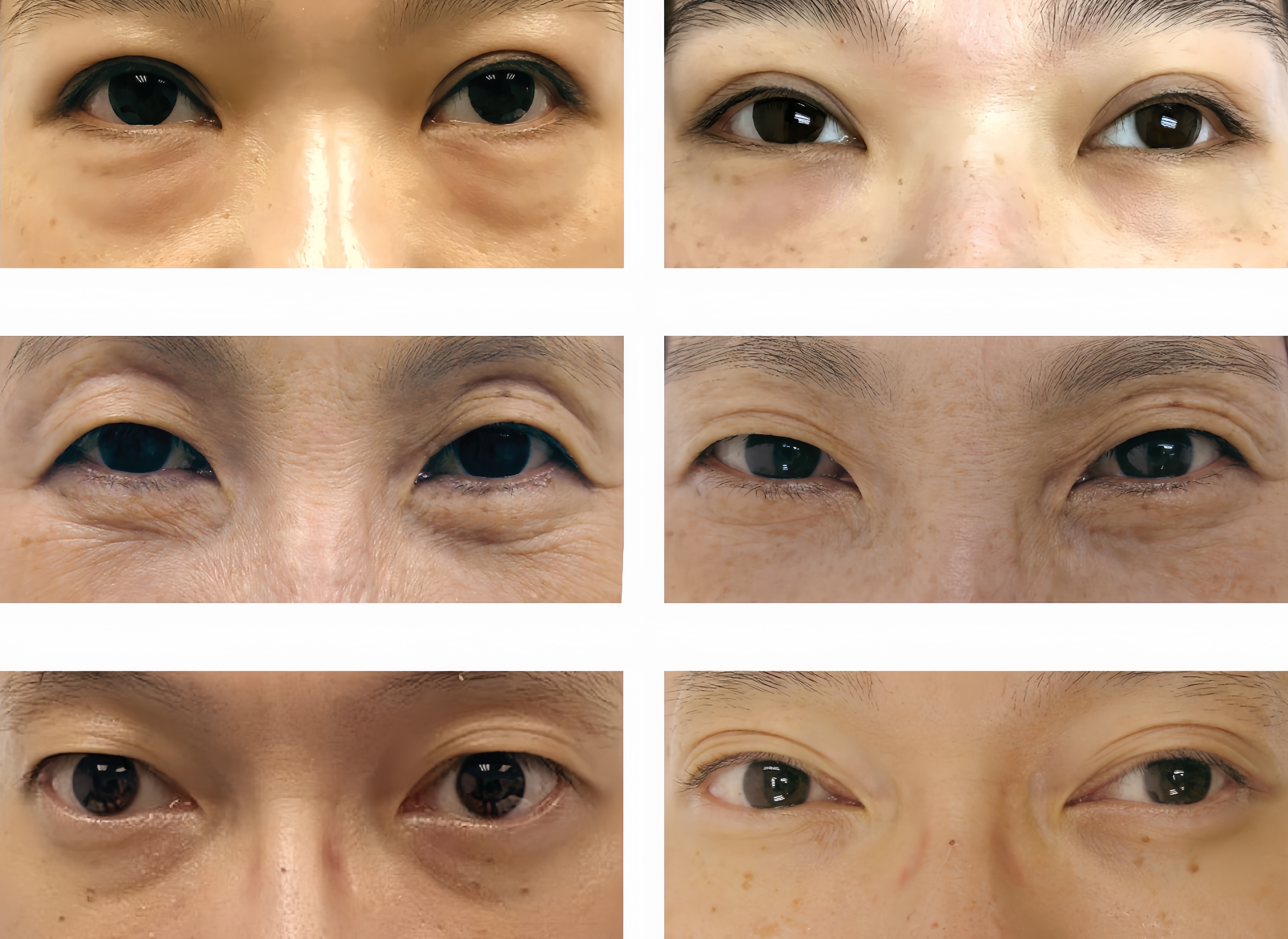 精靈眼重建療程90mins-6次