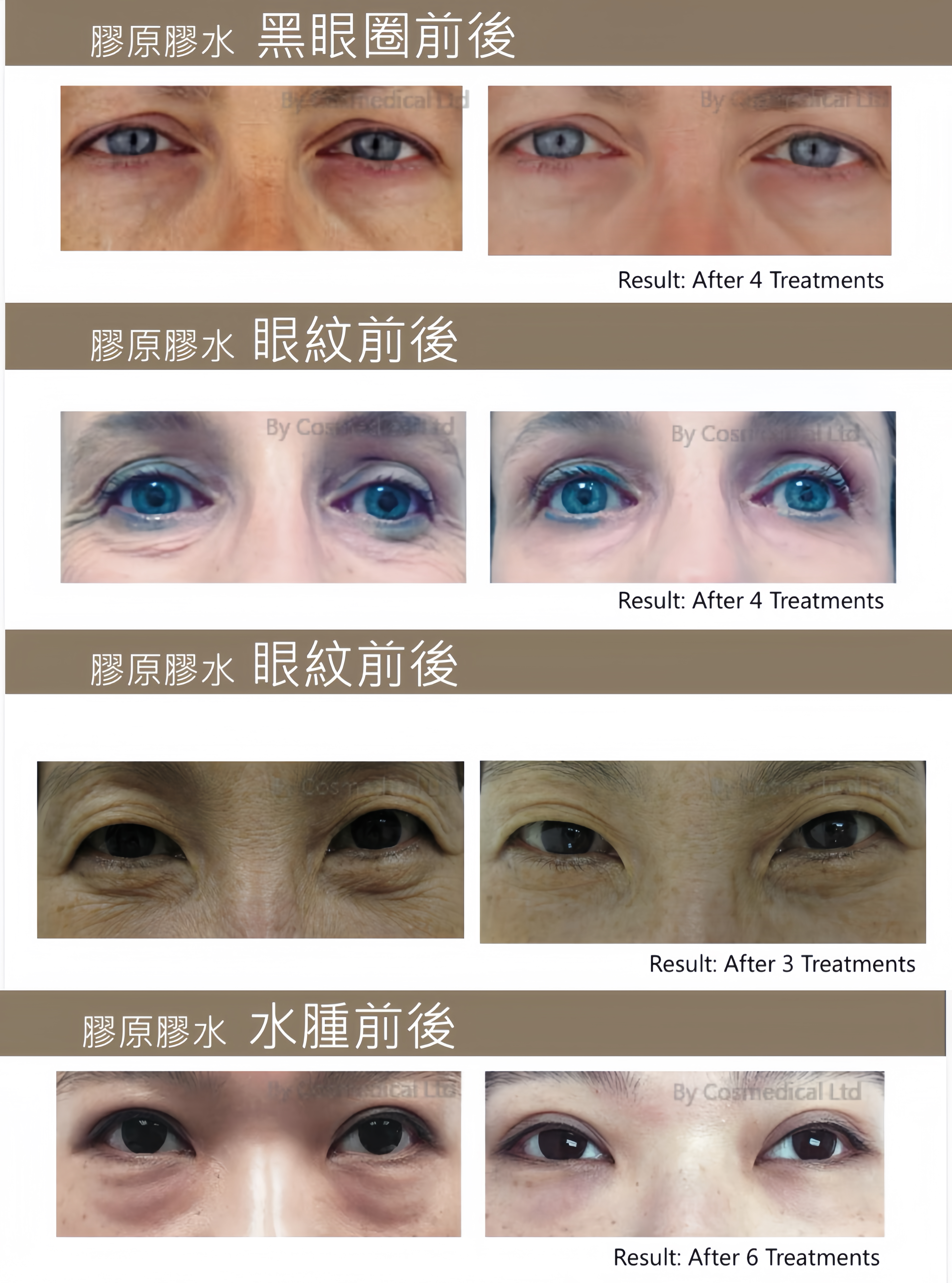 精靈眼重建療程90mins-6次