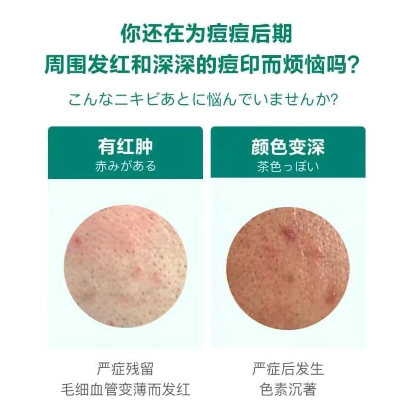 🇯🇵【 日本小林祛痘印淡化黑色素 】10G