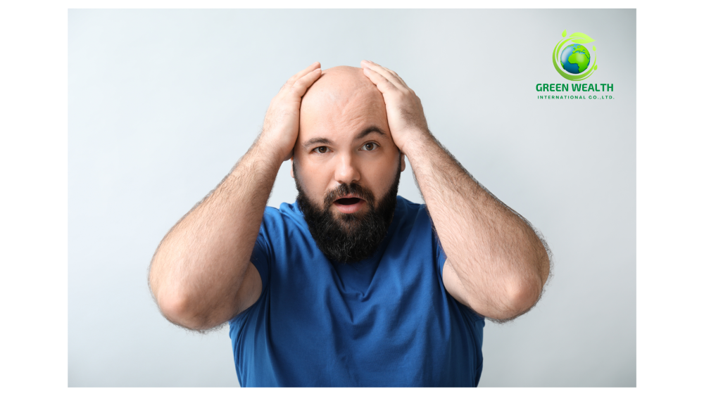 https://www.greenwealthinternational.com/wp-content/uploads/2024/11/Baldness-hair-loss-thinning-hair-8.png