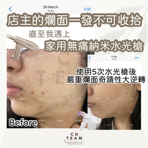 【 Geoskincare CH Team 消費券專享優惠 】家用無痛納米水光槍新手入門套装