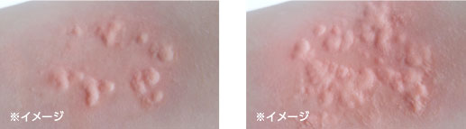 曼秀雷敦 - 止癢蕁抗炎不含類固醇風疹麻疹軟膏