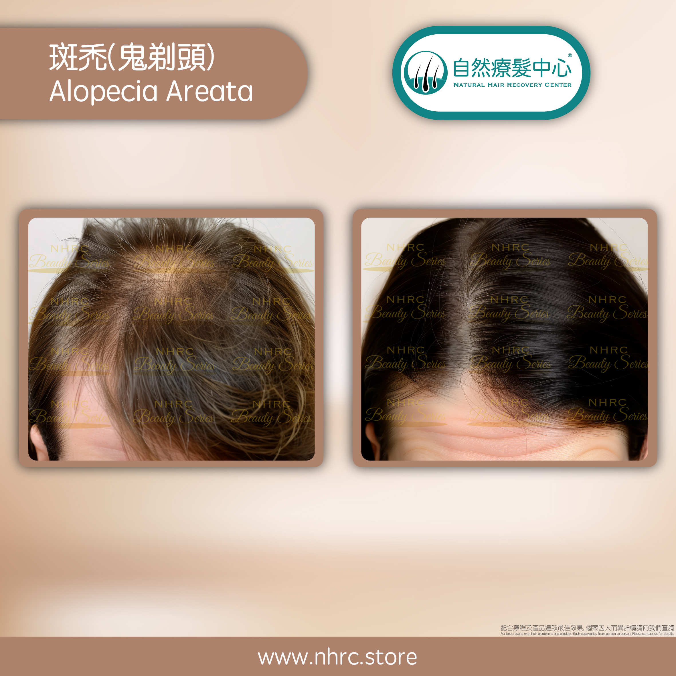 鬼剃頭 Alopecia Areata