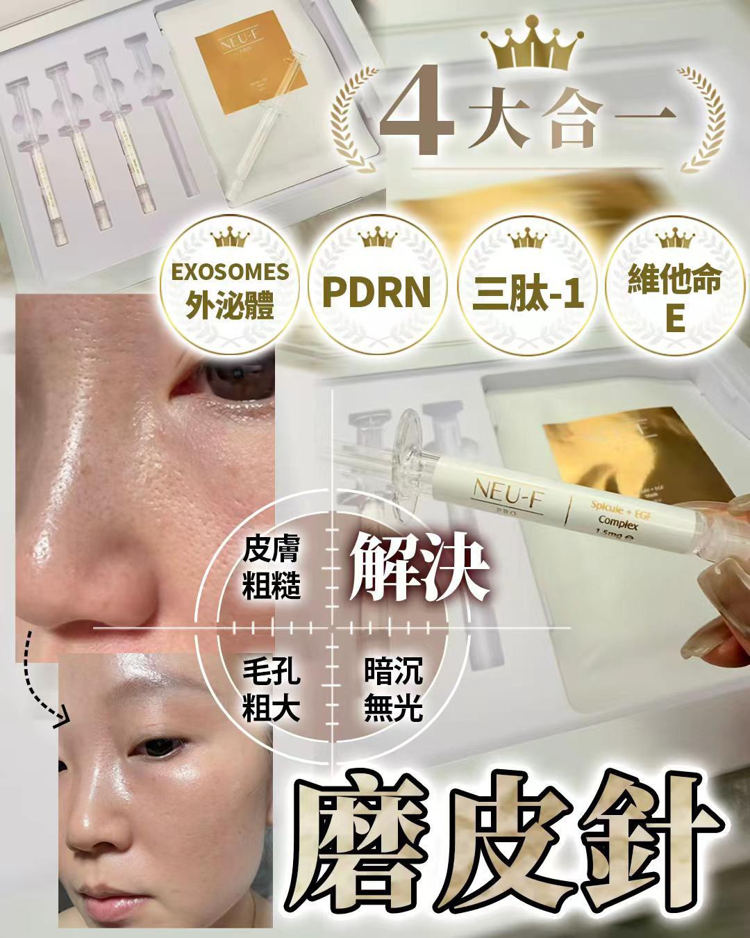 Neu-F  磨皮針(1盒4set)