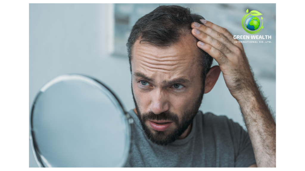 https://www.greenwealthinternational.com/wp-content/uploads/2024/11/hair-loss-in-men-1024x576.png