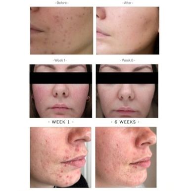 [組合優惠] ANP Skin Accumax 祛痘淨滑療程