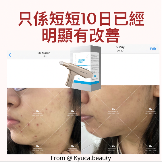 【 暗瘡肌必備 】FN再生修復精華原液 ( 一盒8支 )