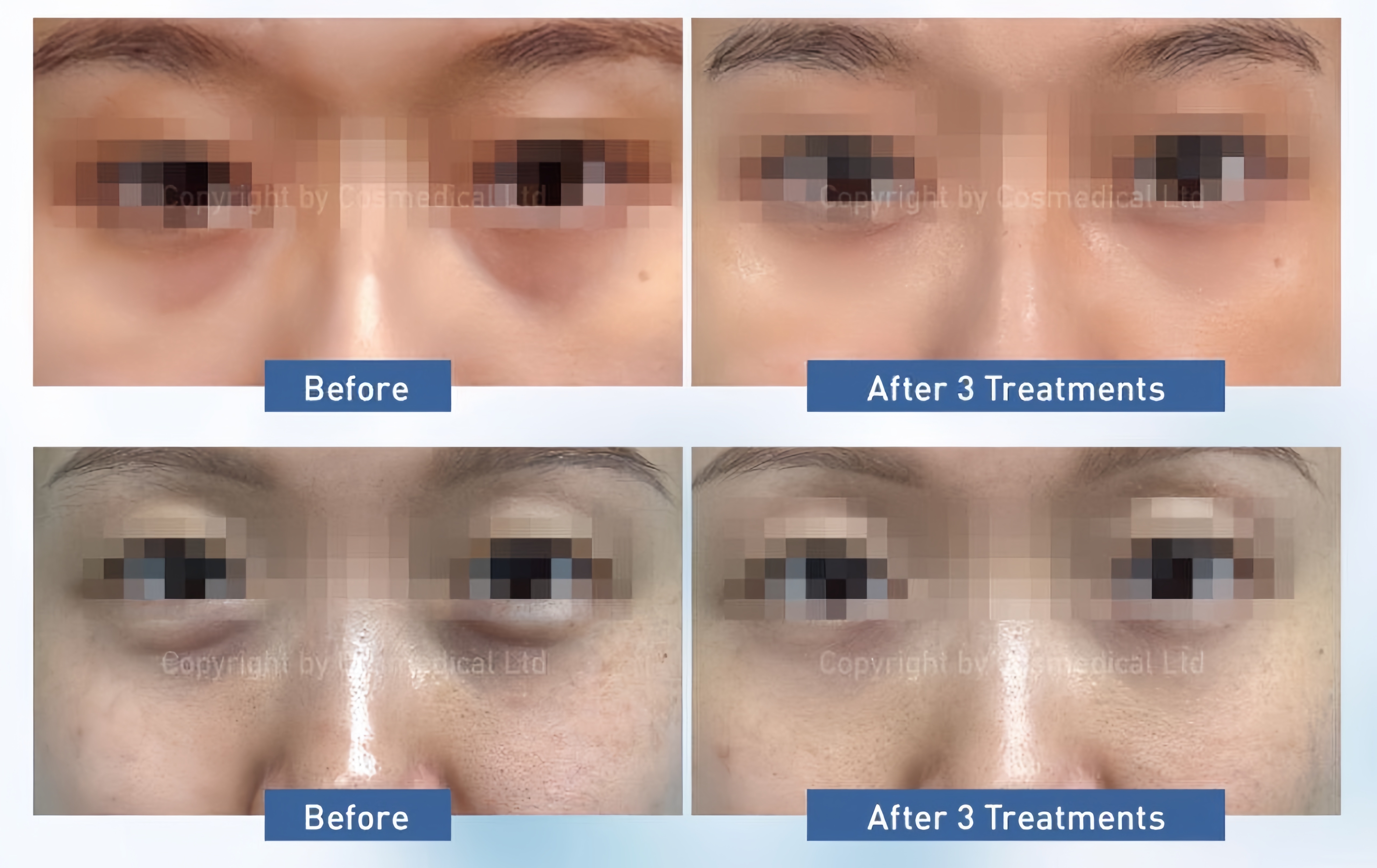 精靈眼重建療程90mins-6次