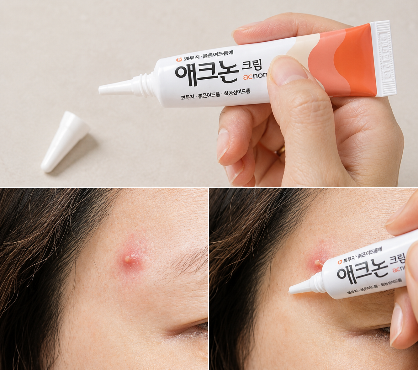 「石頭瘡剋星」Acnon Cream 痘痘修復膏 13g