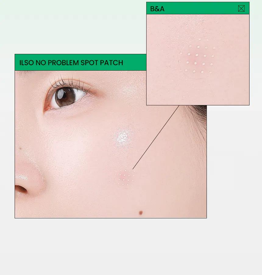 ilso 強效控油降紅保濕痘痘隱形貼 72貼