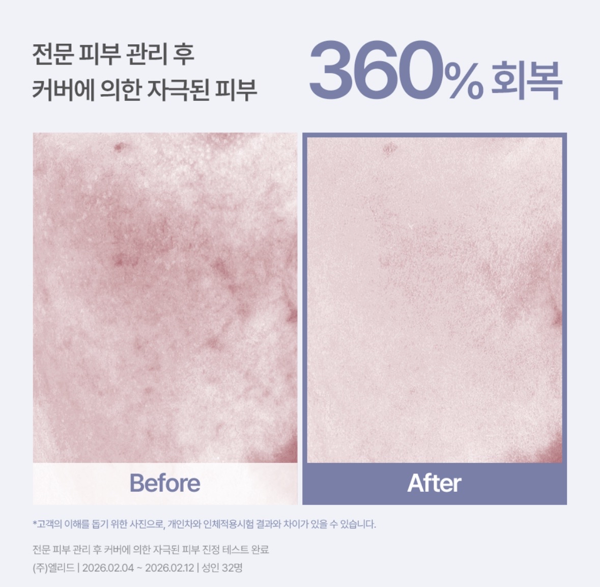 [韓國espoir] espoir x AESTURA 共同研發 BB Derma Cover BLEMISH BALM SPF50+ PA++++ 限時送AESTURA Cleansing Form 2x30g (預購商品）