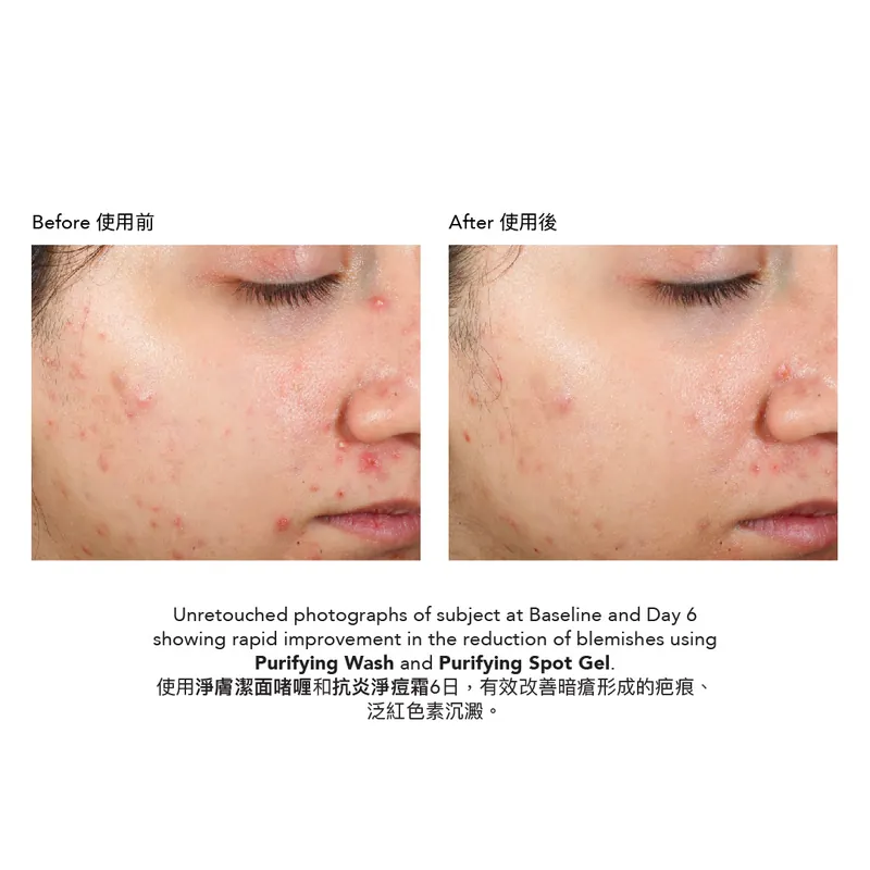 Epionce Purifying Spot Gel 抗炎淨痘霜