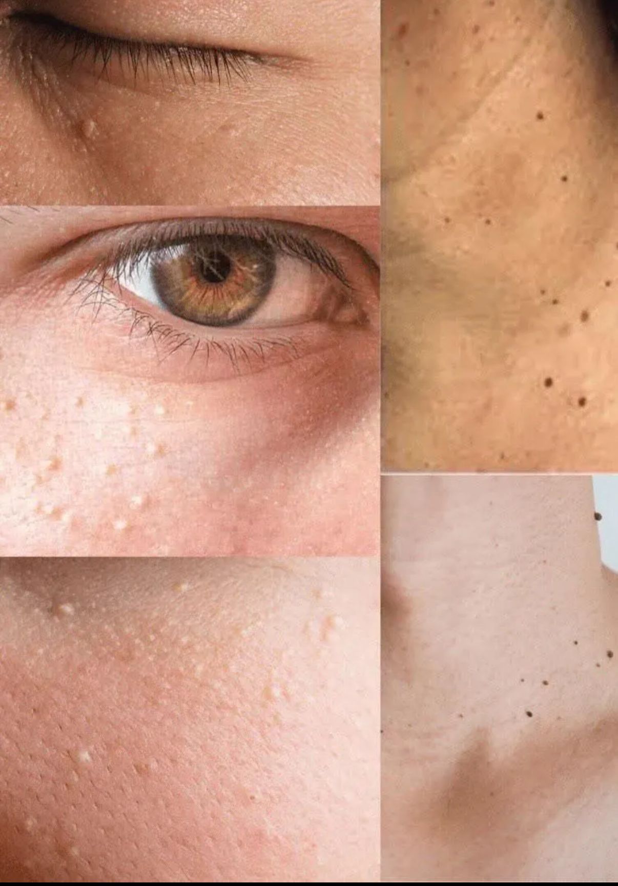 Tsubuporon 專業去角質粒膏（夜用藍色 Tsubuporon 專業去眼角質粒膏（啡色） Liberta 專業去角質粒系列 - Tsubuporon つぶぽろん 溫和酸類配方 + 日本漢方草本精華 擺脫煩人的角質粒、油脂粒，讓肌膚回復光滑嫩肌！ LIBERTA 特別研發出眼周專用的去眼角油脂粒眼霜，更於 2018 年榮獲樂天第 1 位！ - 含甘醇酸及22種漢方草本精華，性質溫和不刺激 - 利用温感去加速新陳代謝、溶解脂肪 - 保濕眼周肌膚，同時軟化眼周油脂粒 - 產品上柔軟纖維刷頭為敏感脆弱的眼周肌膚而設 - 只需塗抹在油脂粒上，不用大面積使用 - 每天持續使用，利用產品上的柔軟刷頭輕輕摩擦眼周油脂粒，約3-4星期後，輕鬆去除油脂粒（效果可能會因人而異） -