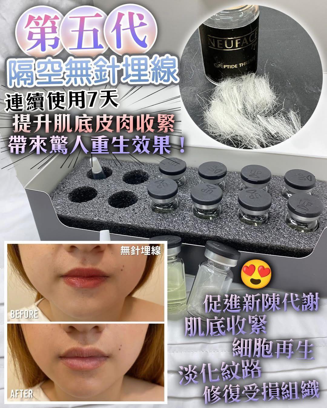 Neuface Pro 全新第5代隔空無針埋線升級版  (訂貨4-7天)