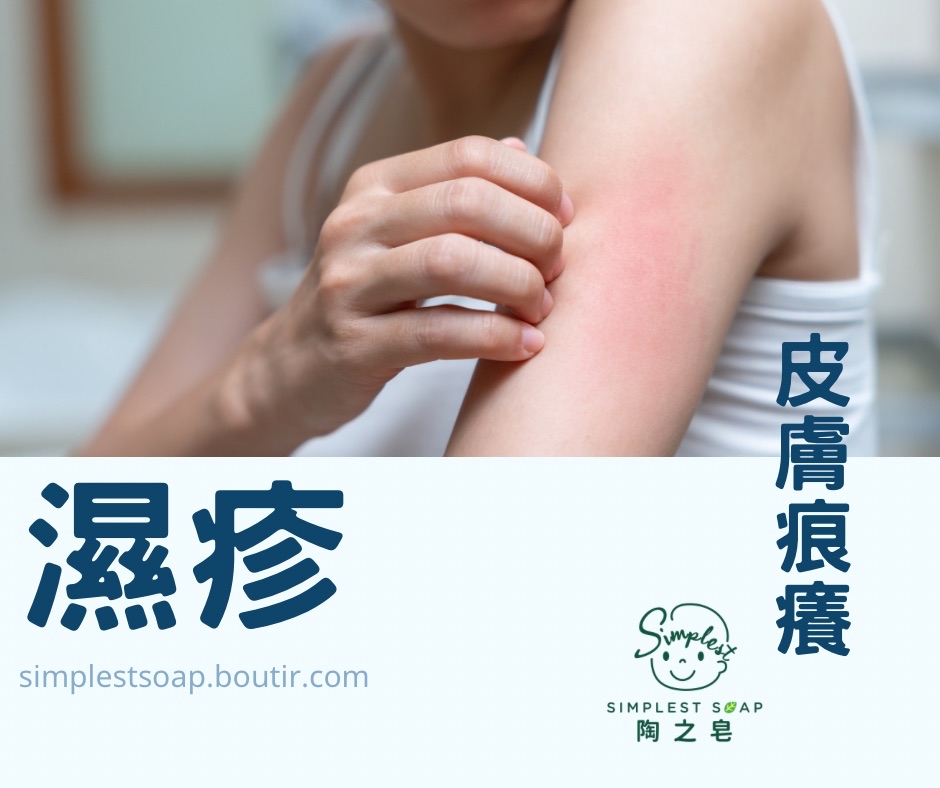 【受濕疹困擾❓簡單三個步驟處理👍🏻】