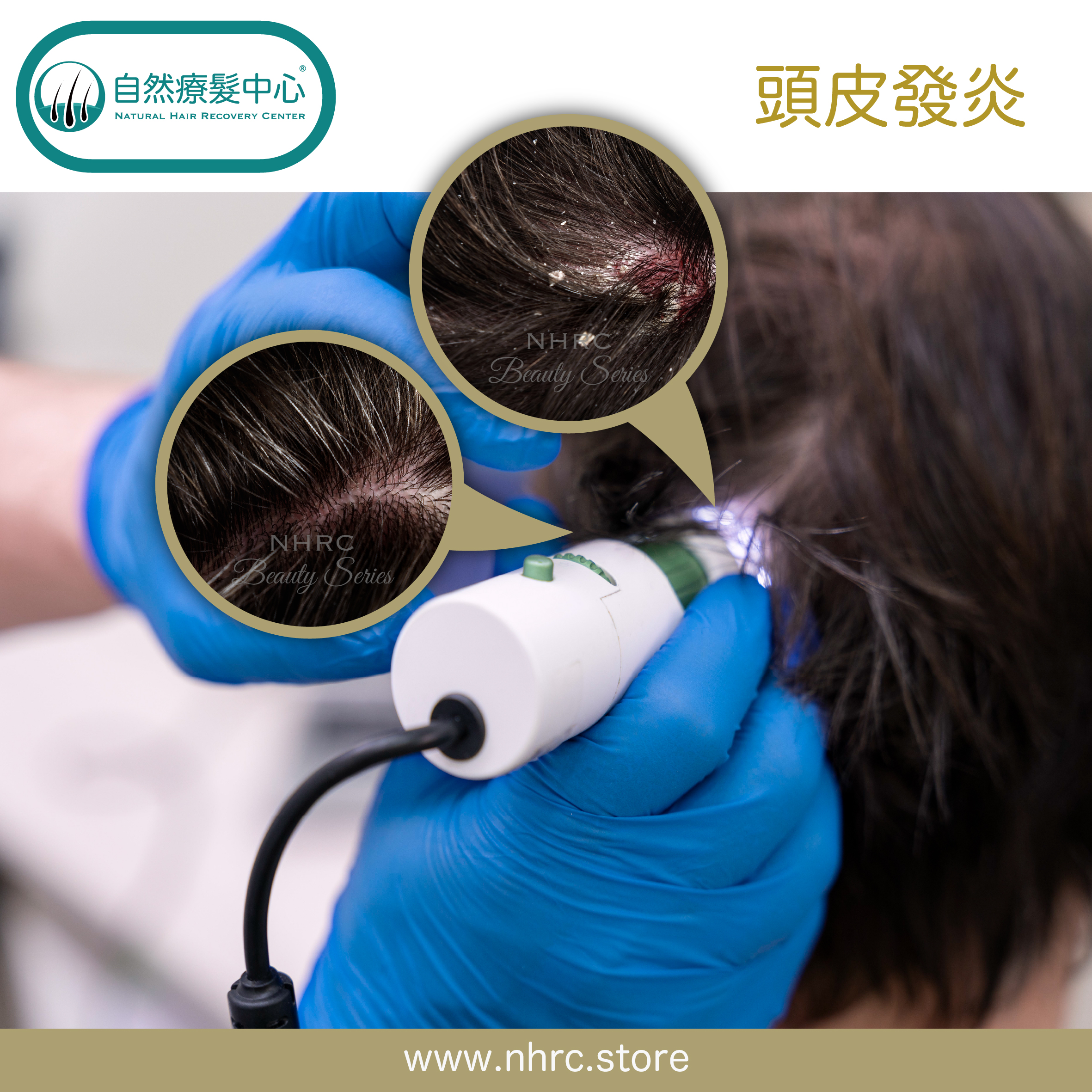 頭皮發炎Scalp Inflammation