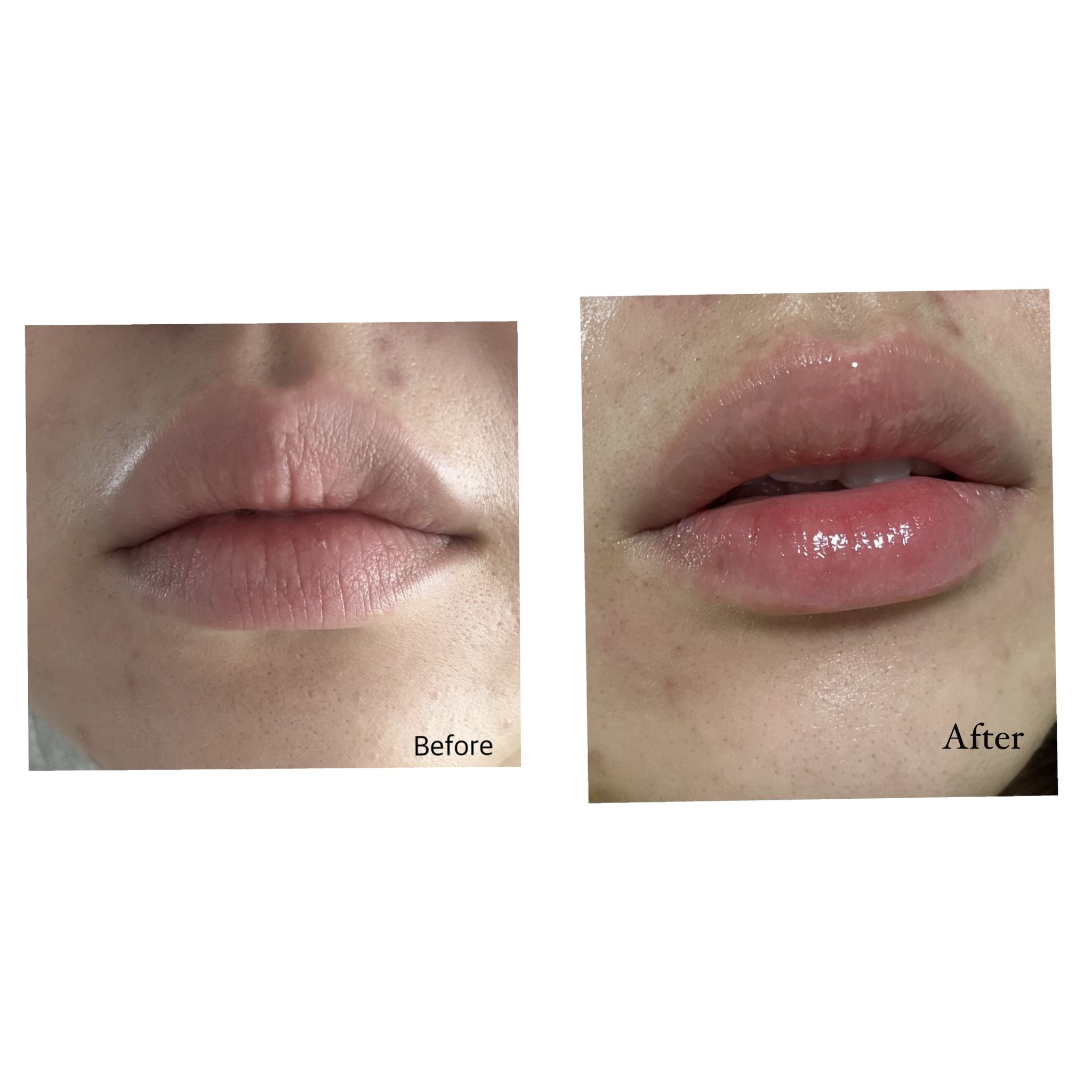 Reju-All PDRN 潤唇精華💥熱賣產品