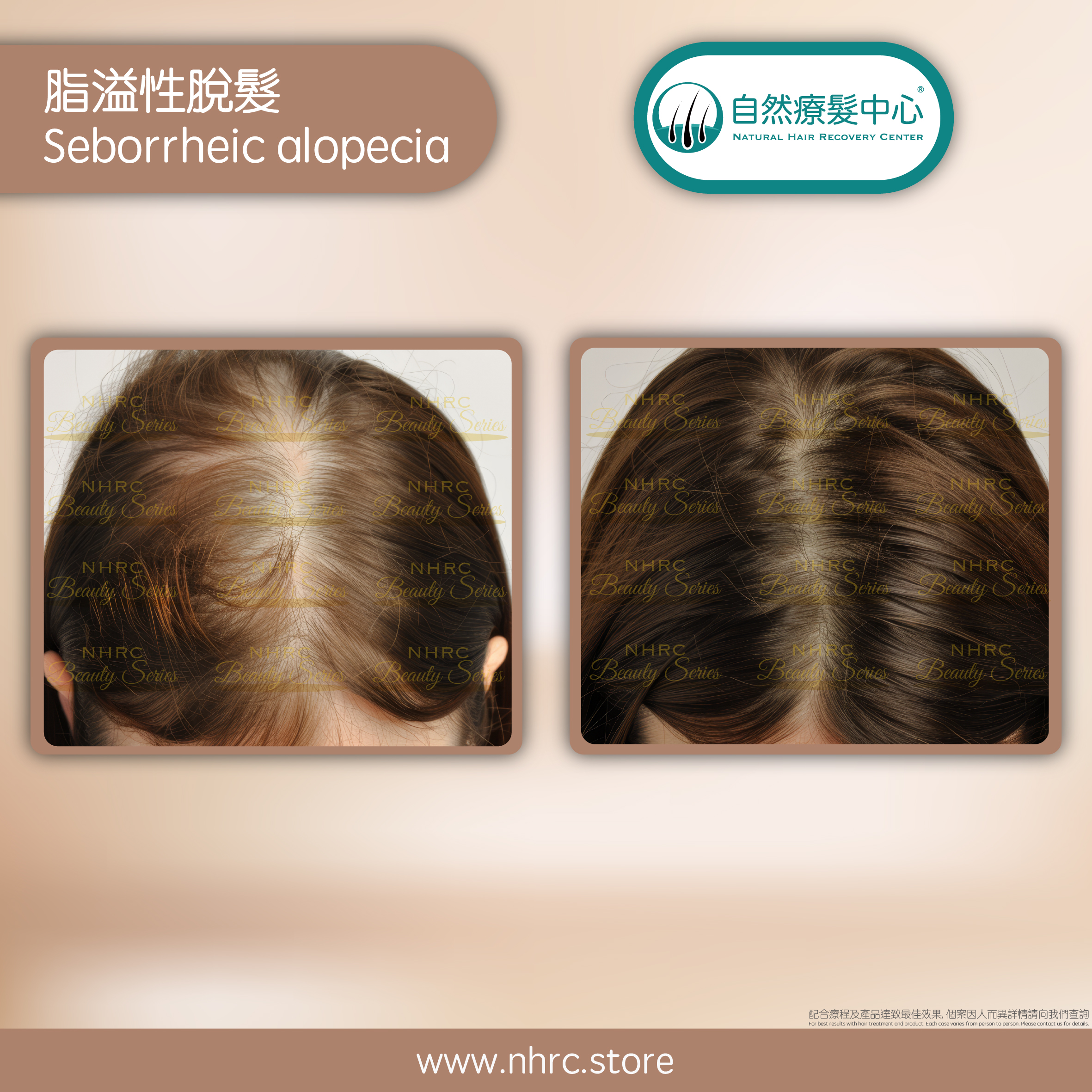脂溢性脫髮 Seborrheic alopecia