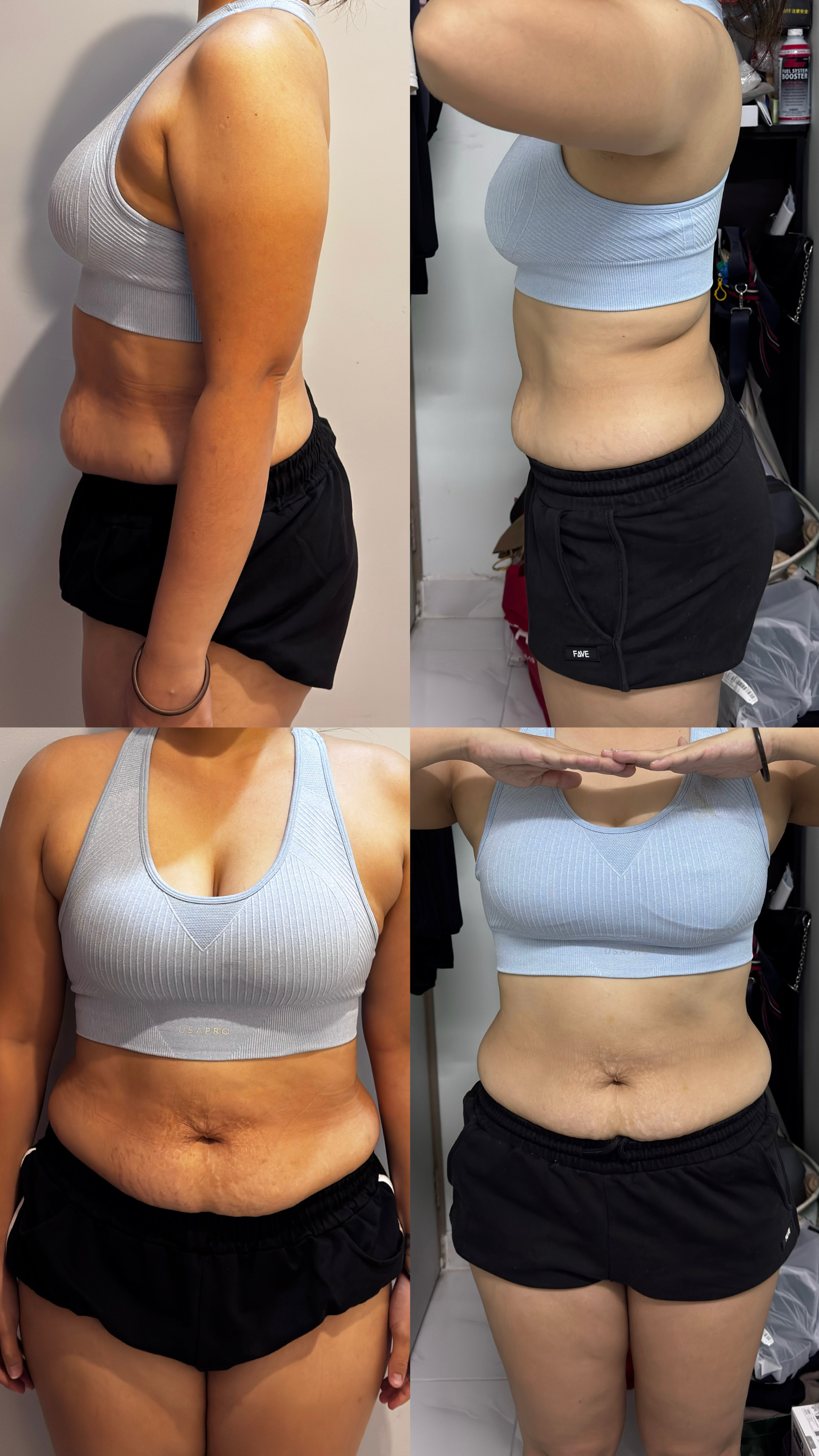 🇲🇾 5 盒 完整一个疗程配套 （ 可服用 30-45 天 ）