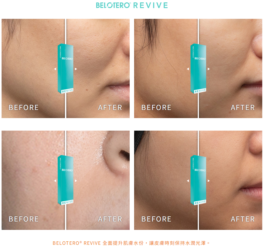 【Infinite Medical】Belotero® Revive 水光針｜多位kol指定醫生｜超過9成回頭率