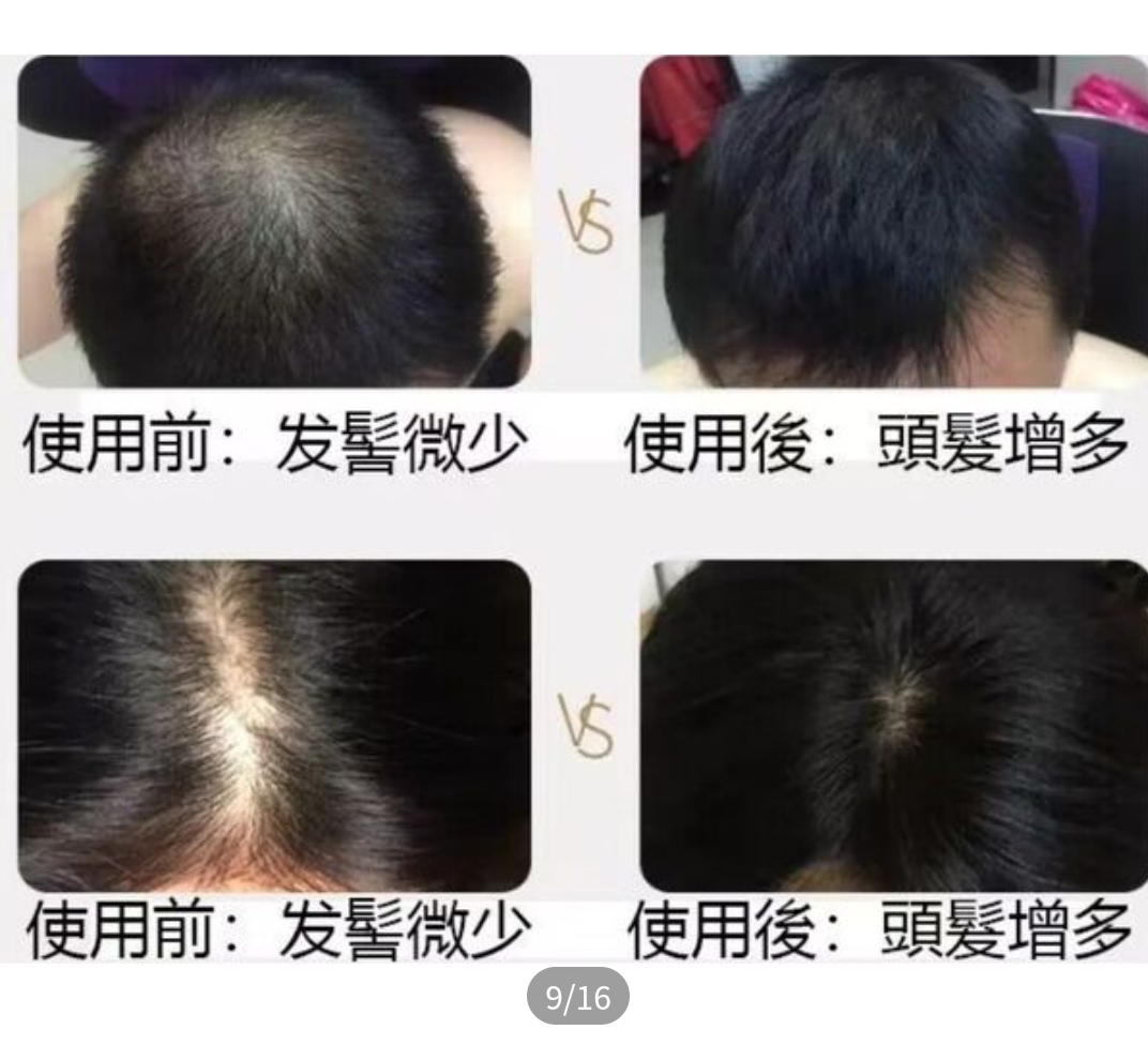 韓國 VT PDRN Reedle Shot 700dL 頭皮護理精華 15ml | 700微針導入 | PDRN強效育髮 | 防脫密髮