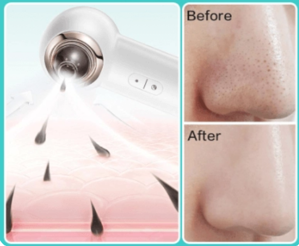 日本JUJY可視冷熱敷黑頭粉刺機