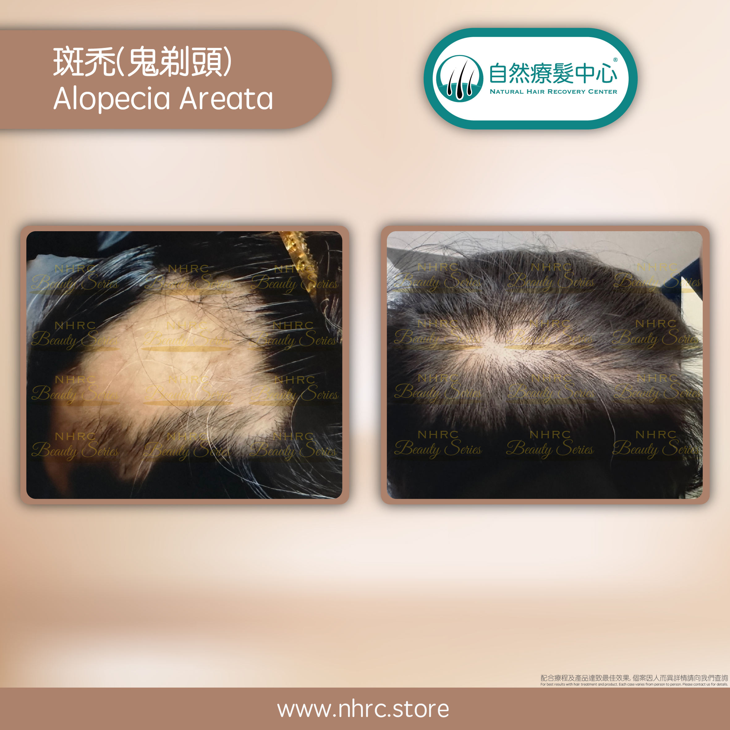 斑禿(鬼剃頭)Alopecia Areata