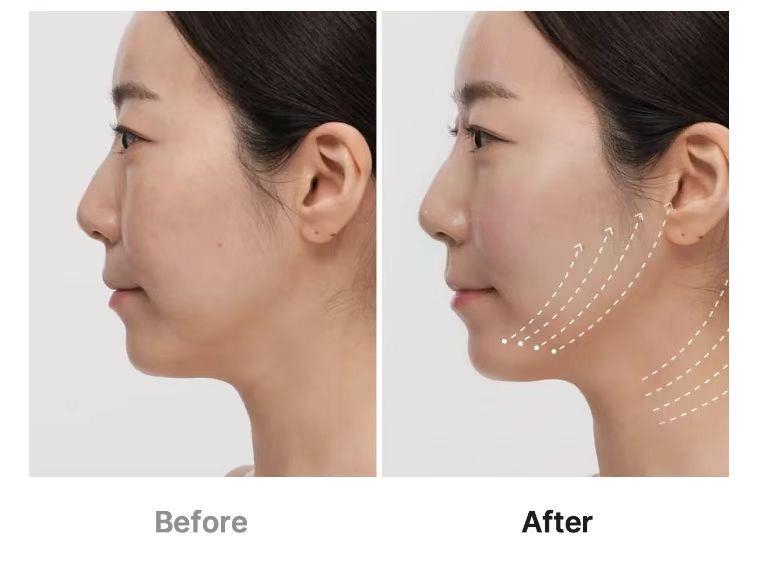 預訂預訂 Medicube AGE-R Ultra Tune 40.68 MHz高頻（RF） （保養期一個月）