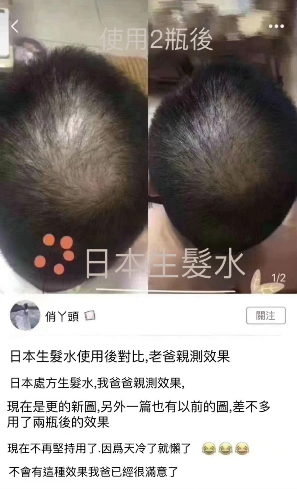日本🇯🇵藥局生發水 🇯🇵這款生發水李晟，何炅也說過這個好用。有脫發，禿頭，發際線不飽滿困擾的都可try！日本🇯🇵處方藥生發液，只有藥局有售！3瓶一療程