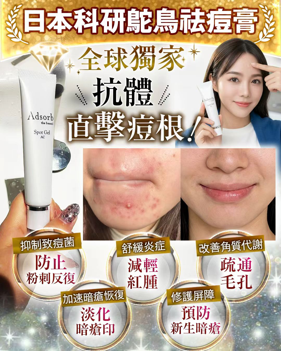 Adsorb 快速謝暗瘡啫喱 25G（鸵鳥抗體原料護膚品）  (*預訂7-10天)