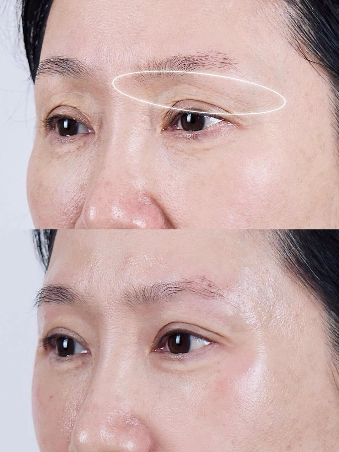 Protop S8 PCL 少女針眼部微針精華 (3ml)