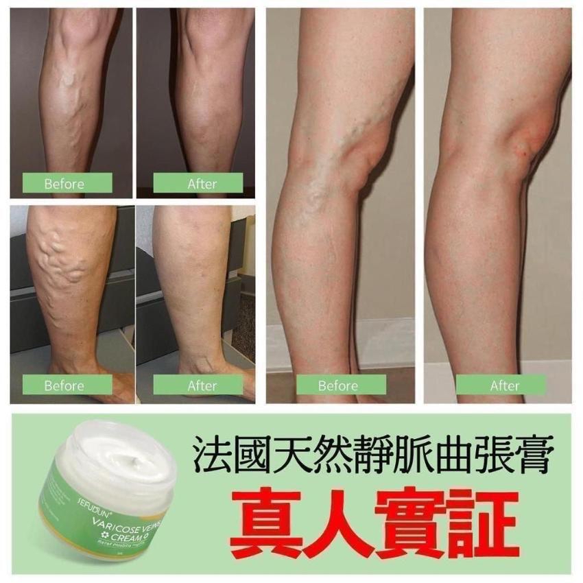現貨- Sefudun靜脈曲張膏50g