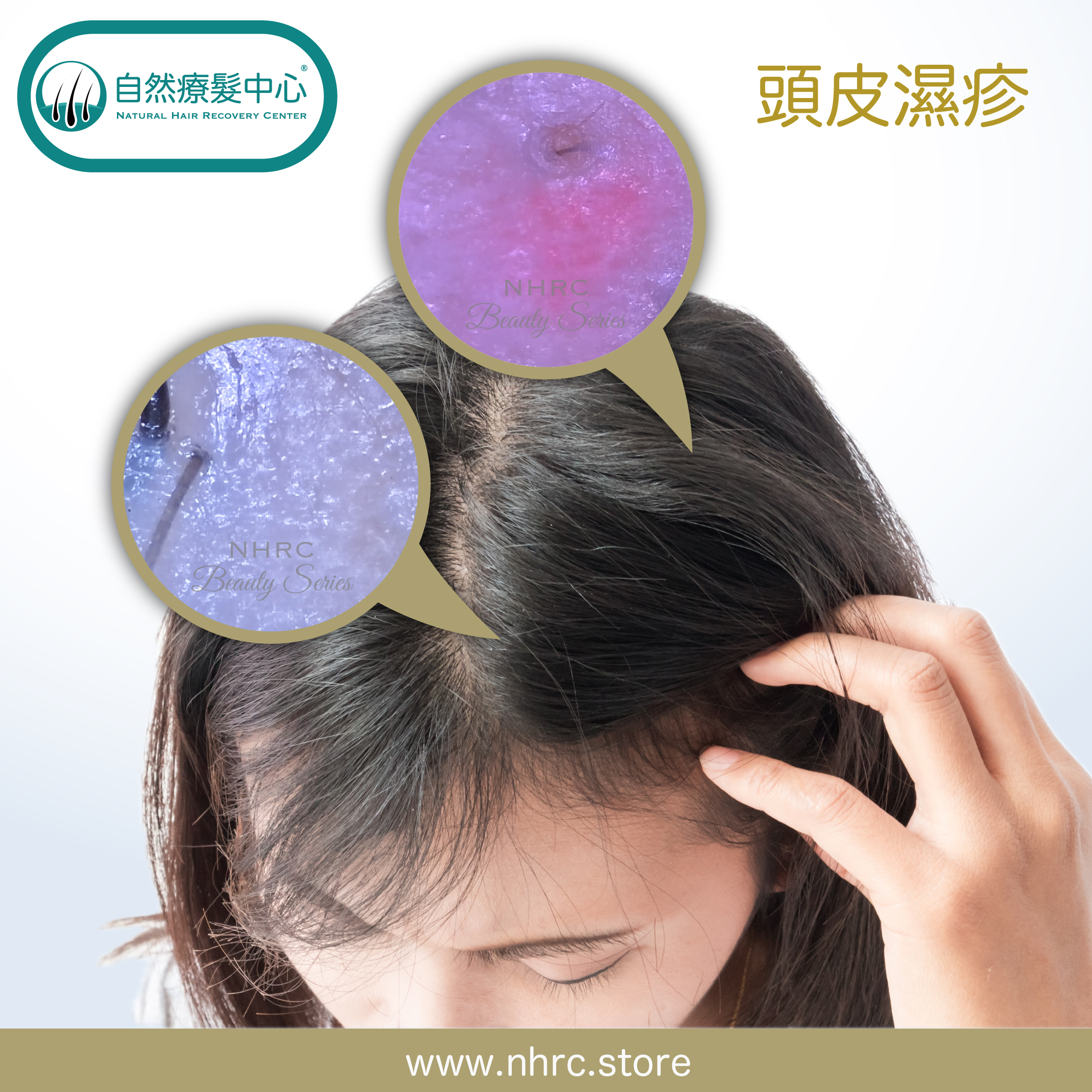 頭皮濕疹Scalp Eczema