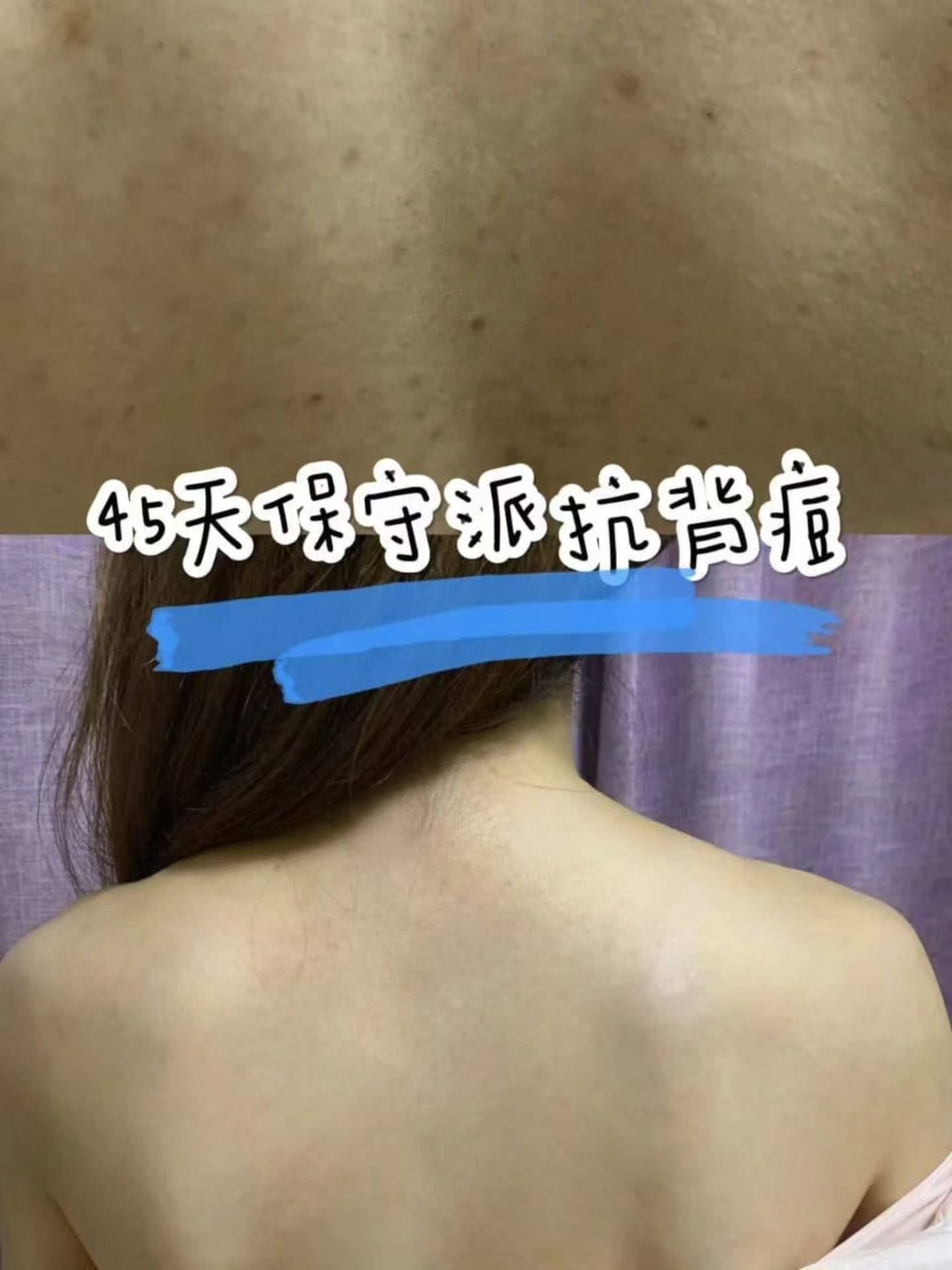 🇯🇵【日本 小林背部除痘喷雾】100ML